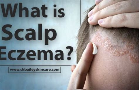 What Is Scalp Eczema Eczema Scalp Scalp Dermatitis Dandruff