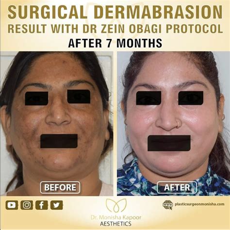 What Is Dermabrasion Procedure Patient Story And Aftercare