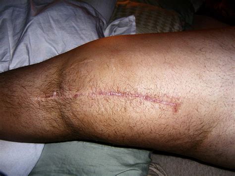 Scar tissue reduction continues for knee replacement surgery after two weeks of manual lymphatic drainage and taping. TKR Scar | Flickr - Photo Sharing!