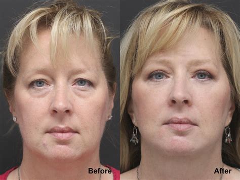 Neck Lift Photos Princeton Nj Patient 7811