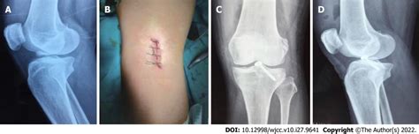 A 38 Year Old Male Patient With Tibial Avulsion Fracture Of The Left