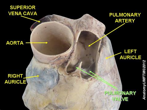 Pulmonic Regurgitation Pathophysiology Wikidoc