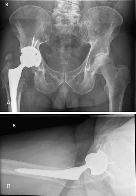Recurrent Hematomas Within The Iliopsoas Muscle Caused By Impingement