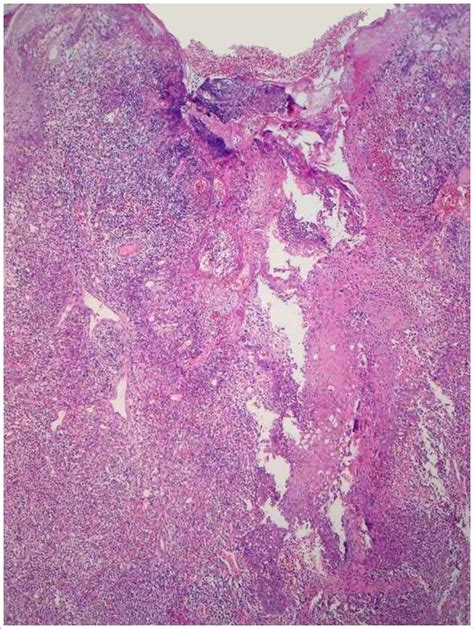 Sycosiform Tinea Barbae Caused By