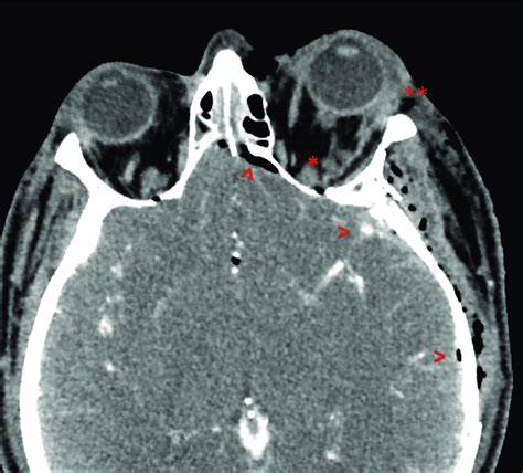 Computed Tomography Scan Showing Left Sided Proptosis With Marked