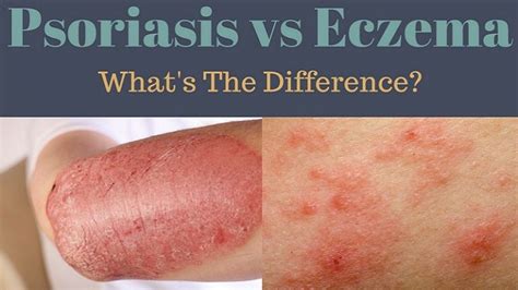 Psoriasis Vs Eczema Whats The Difference Between Them