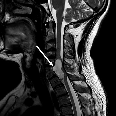 Cervical Spinal Cord Lesion Mri