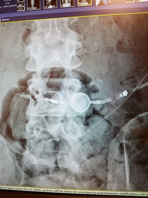 Rarely Defined Lumbar Shunt Catheter Out Of Place A Revision Surgery