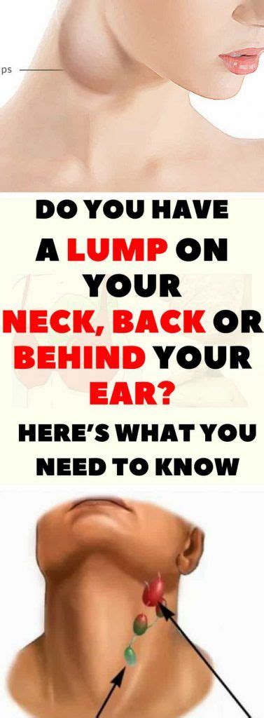 Do You Have A Lump On Your Neck Back Or Behind Your Ear Heres What