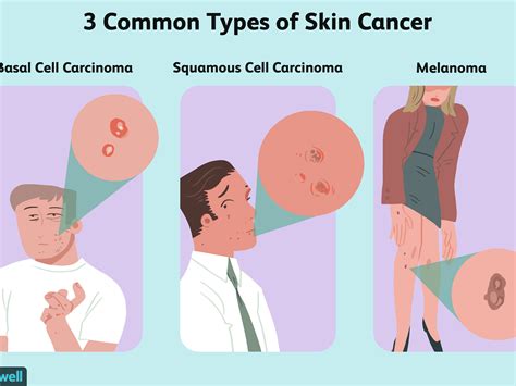 Face Skin Cancer Signs And Symptoms Steve