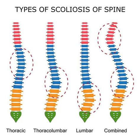 Scoliosis Facts