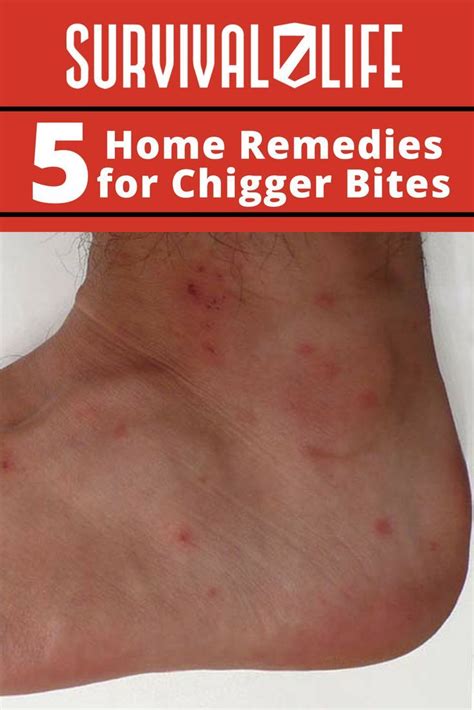 5 Home Remedies For Chigger Bites Artofit