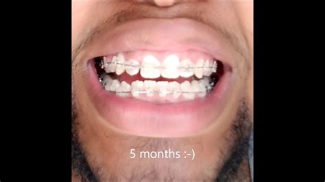 Braces 6 Month Timelapse Youtube