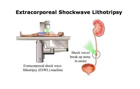 Eswl External Shockwave Lithotripsy Urologist Bhopal