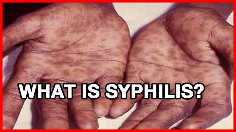 What Is Syphilis Youtube