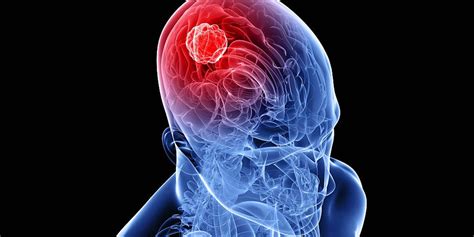 Research Device Claims To Suppress Brain Cancer Cell Growth