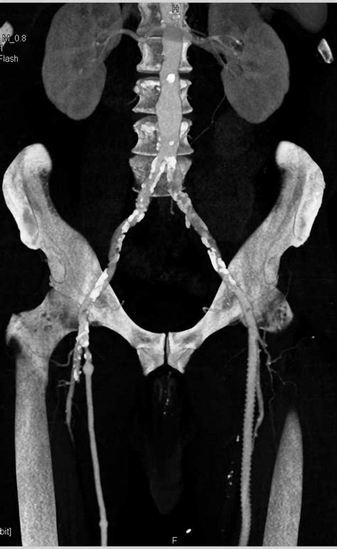 Cta With Left Superficial Femoral Artery Sfa To Popliteal Artery