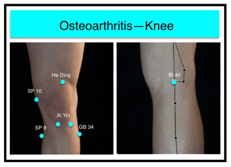 Knee Pain And The Older Patient Acupuncture Technology News
