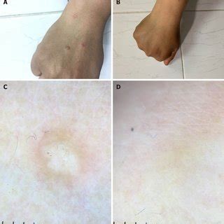 Shows Lichen Planus Papules On The Hand Of A Patient A Before And B Download Scientific