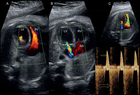 Aortic Valve Fetal Ultrasound