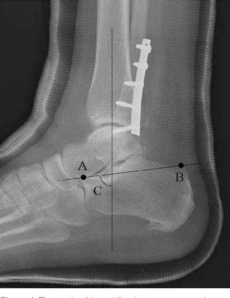 Figure 1 From Pain And Dorsiflexion Range Of Motion Predict Short And Medium Term Activity