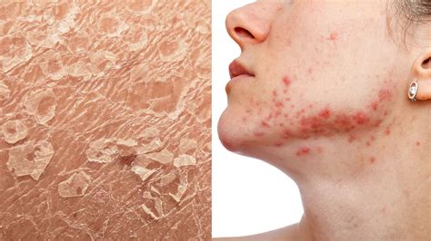 Dermatologists Reveal Signs Of Stressed Skin And How To Heal It Rough Facial Skin Dry