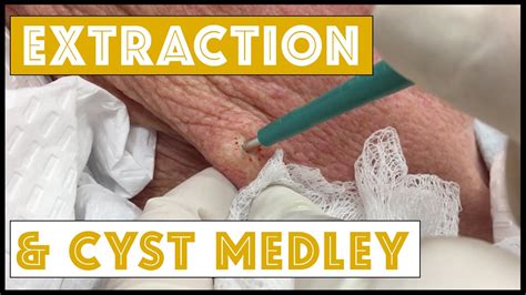 Extraction And 2 Cyst Medley Youtube