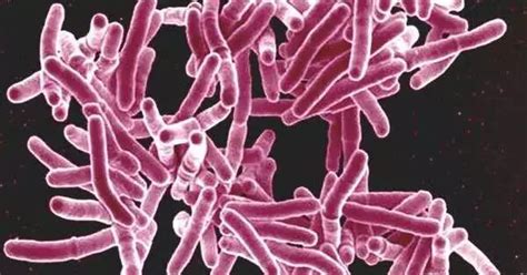 Bone Eating TB Outbreak Was Mysterious And Resembled An Earlier Variety