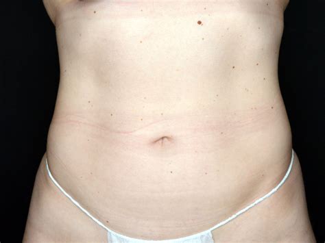 before and after coolsculpting — cpw vein and aesthetic center