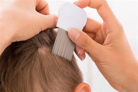 Is It Lice Or Dandruff Lice Clinics Of America Lexington