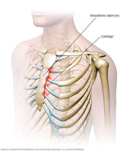 Costochondritis Symptoms And Causes Mayo Clinic