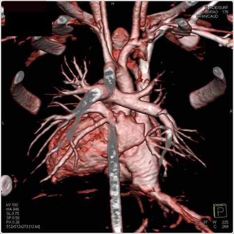 Right Pulmonary Vein Stenosis In 3d Cardiac Case Studies Ctisus Ct