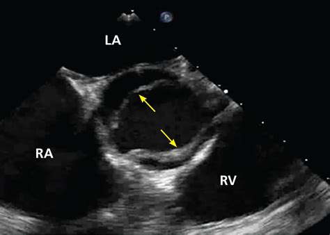 Bicuspid Aortic Valve Basics And Beyond Cleveland Clinic Journal Of
