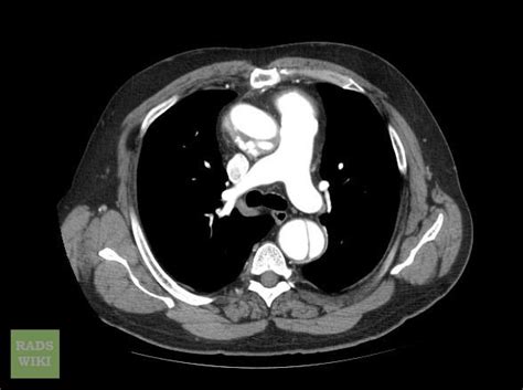 Aortic Dissection Ct Wikidoc