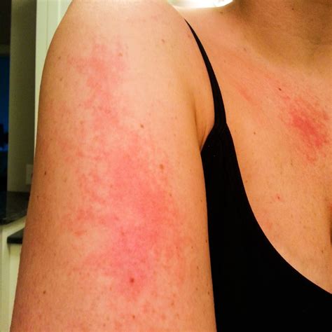 All 104 Images Types Of Armpit Rashes With Pictures Sharp 102023