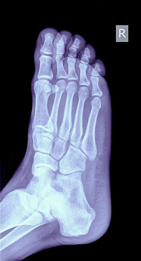 Foot X Ray Photograph By Photostock Israel