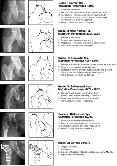 The Cerebral Palsy Hip Classification Is Reliable Bone And Joint