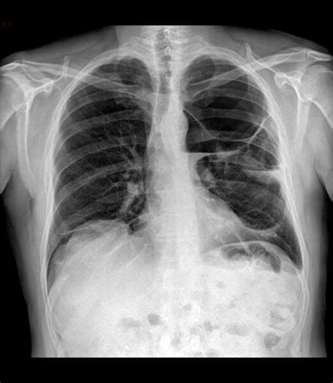 Infected Emphysematous Bulla Radiologist Science Biology Pulmonary