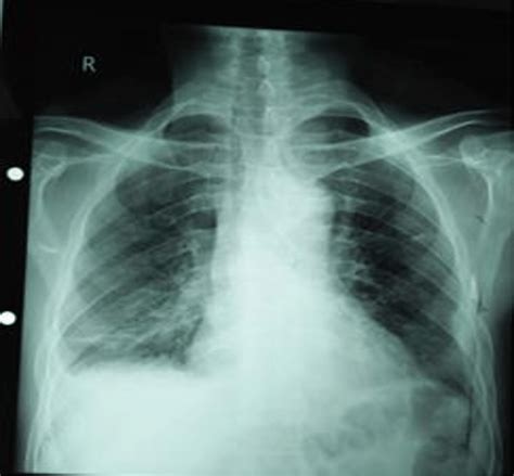 Chest X Ray Of The Patient Showed Bilateral Mild Pleural Effusion More