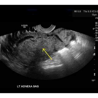 A Sagittal Transvaginal Ultrasound Image Large Heterogeneous Adnexal