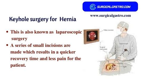 Hernia Repair Kochi Laparoscopic Hernia Repair Kerala