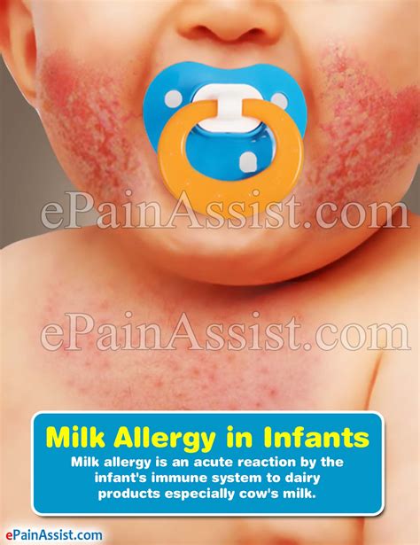 Treatment of allergies to milk. Milk Allergy in Infants|Causes|Symptoms|Tests|Treatment