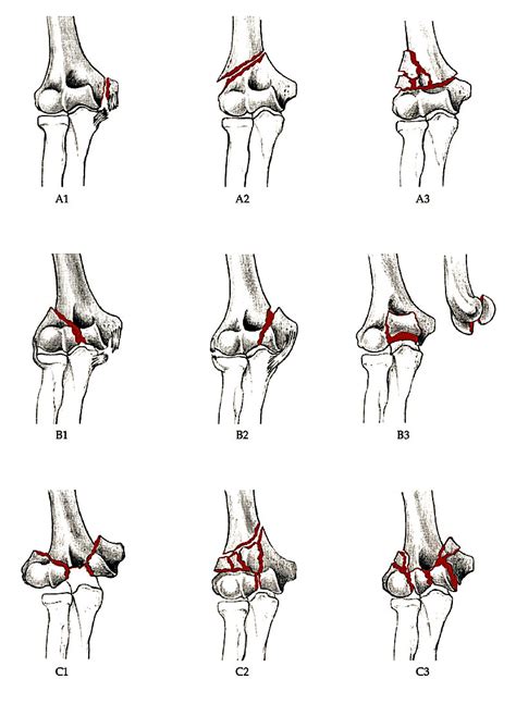 Ao Ota Classification Of Distal Humerus Fractures From Journal Of