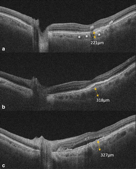 Misclassified Cases A A Case Of Non Pachychoroid Misclassified As