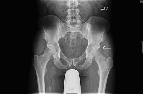 Anteroposterior Pelvis Radiograph Of A 48 Year Old Male Hip With