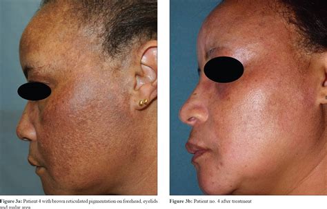 Generalized Facial Pigmentation An Uncommon Presentation Of Cutaneous