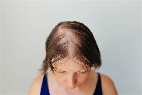 How To Stop Alopecia Areata Neograft Orange County