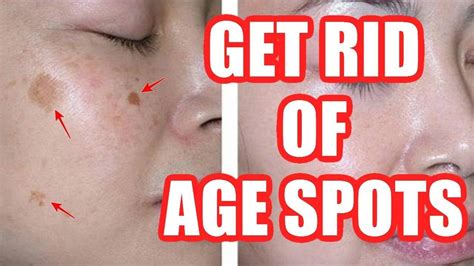 How To Get Rid Of Age Spots On Face Hands Legs Naturally Home