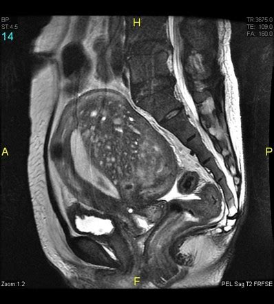 Myometrial Cysts Radiology Reference Article Radiopaedia Org