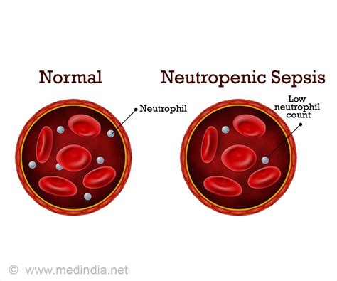 Neutropenia Diagnosis Of Neutropenia Treatment For Neutropenia And 3